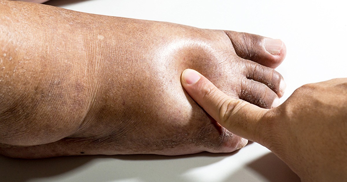 Piedi gonfi per il caldo